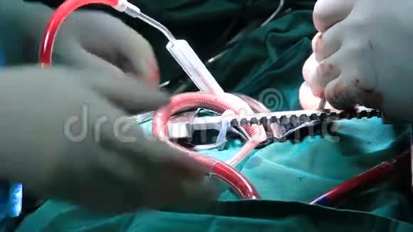 手术室开放心脏手术视频的预览图