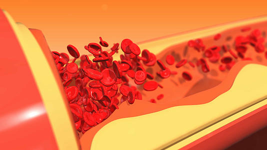 4K三维血栓血管堵塞剖析图背景素材视频的预览图