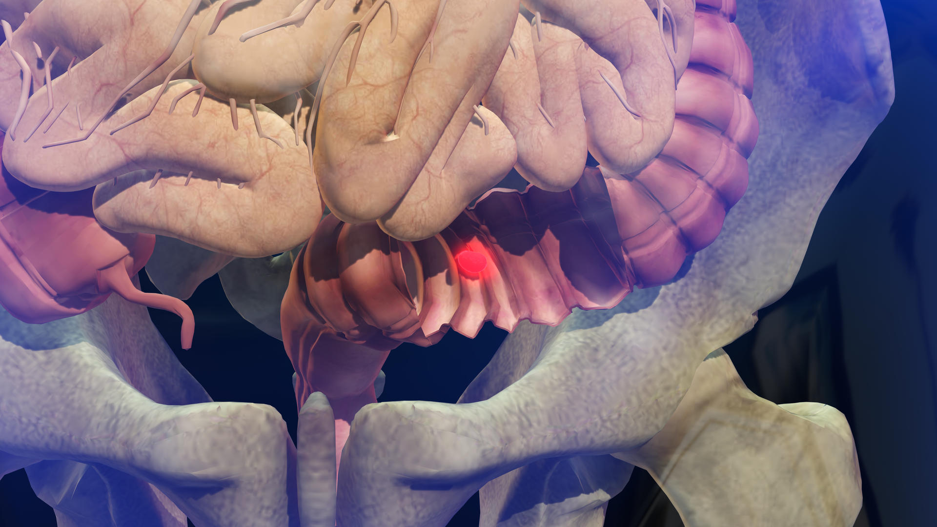 3D人体直肠癌视频的预览图