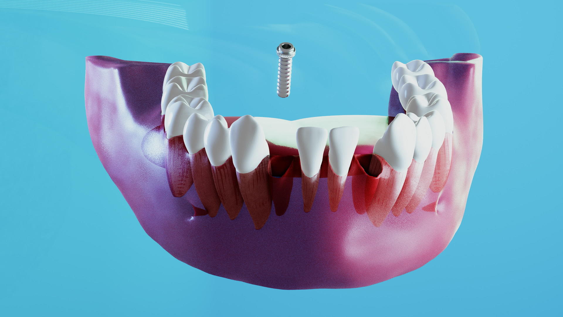 陶瓷牙科植牙程序视频的预览图