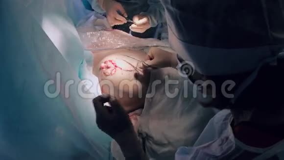 外科医生缝合乳房完成再植手术视频的预览图