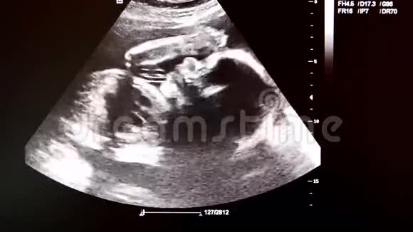 婴儿21周超声监测录像视频的预览图