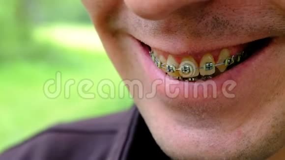 牙齿发黄的支架一个微笑的家伙的特写吸烟人的牙齿浅的景深牙科视频的预览图
