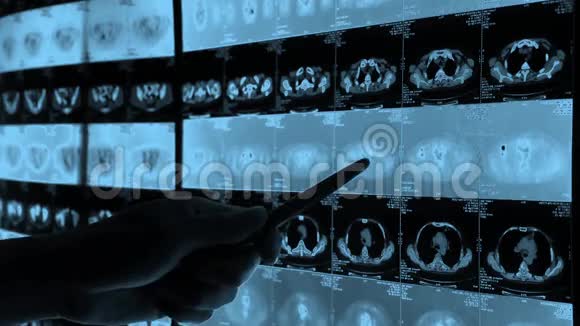医生研究人眼骨宠物ct扫描X线癌症转移视频的预览图