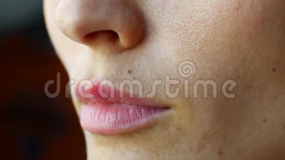 女孩嘴唇上的疱疹视频的预览图