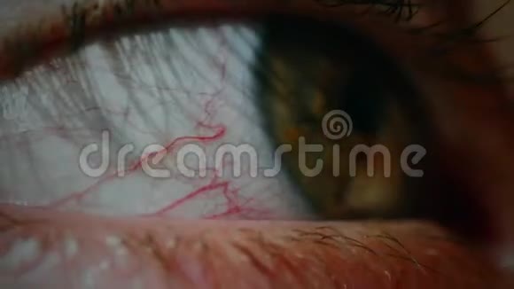 结膜炎红眼视频的预览图