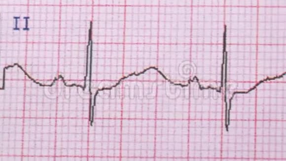 心脏的心电图视频的预览图