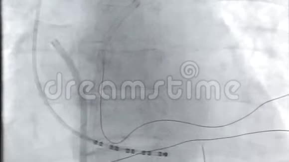 心脏x光视频视频的预览图