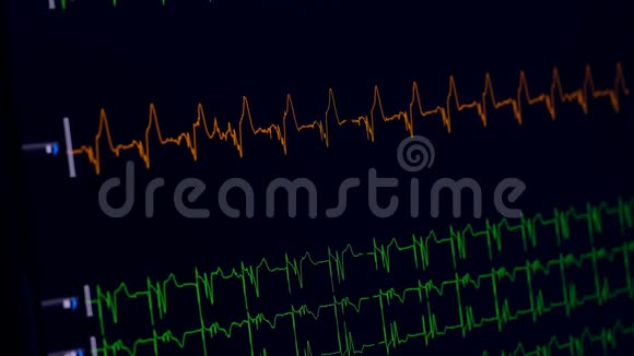 医用心脏监护仪测量心电图视频的预览图