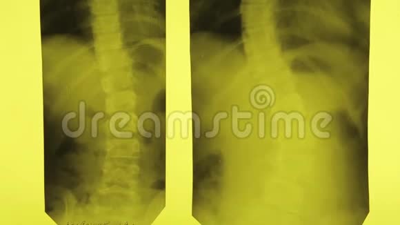 脊柱002的X射线视频的预览图