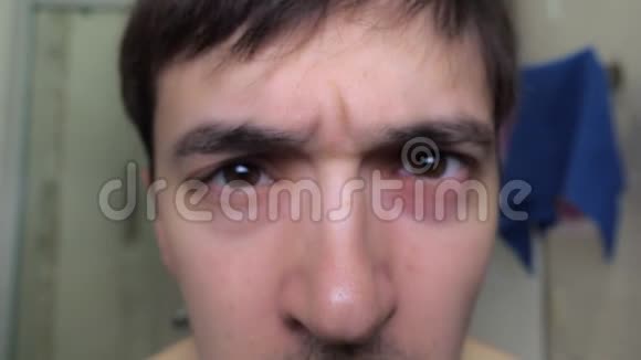 一个过敏青年的棕色眼睛视频的预览图