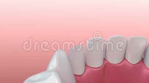 牙科贴面瓷贴面安装程序视频的预览图