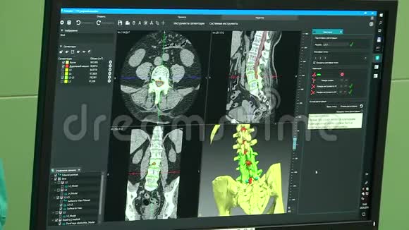 监视器屏幕上脊柱的X光视频的预览图