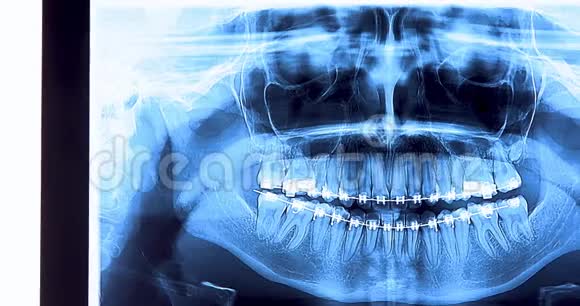 带牙套的牙科X线摄影视频的预览图