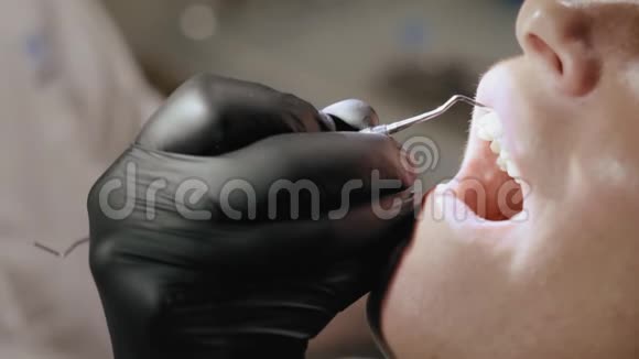 特写牙医的手套表格密封在病人牙齿上视频的预览图