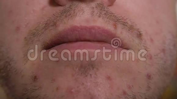 成年男性的脸和胡须上有许多红色的皮疹和麻点水痘视频的预览图