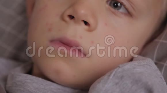 一个患水痘的病童躺在床上的特写照片视频的预览图