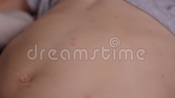 一个小孩皮肤上水痘形成的红色粉刺和水泡视频的预览图