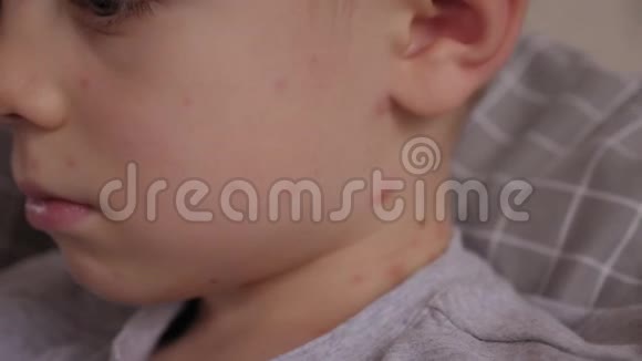 一个很大的水痘水泡的特写在一个小孩子的脖子上视频的预览图