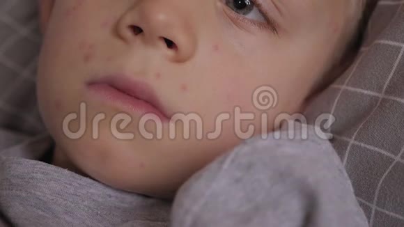 一个患水痘的病童躺在床上的特写照片视频的预览图