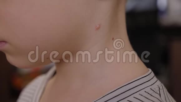 一个小男孩的脖子特写脖子上有一个水痘的水泡视频的预览图