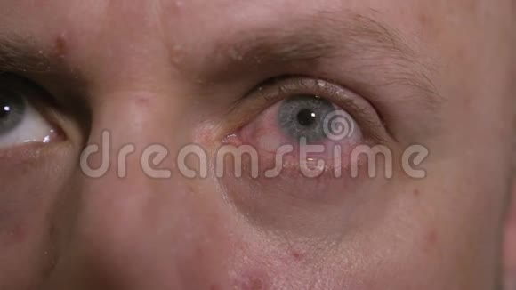 大开红色和刺激人的眼睛的特写过敏症视频的预览图