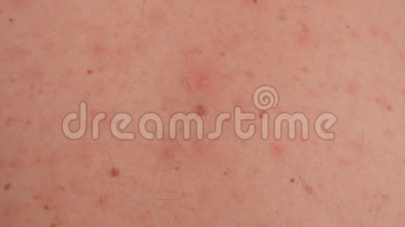 成年男性皮肤上的大皮疹或天花的特写视频的预览图