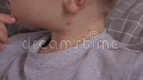 特写一个小男孩的脖子脖子上有水痘的水泡视频的预览图