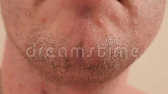 水痘带状疱疹病毒的气泡疹一张有水痘的男人脸的特写视频的预览图