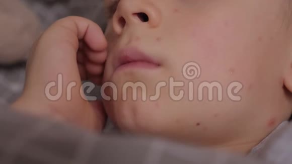 一个得了水痘的小男孩躺在床上抓他脸上的皮肤视频的预览图