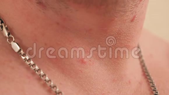 一个成年男性皮肤上水痘中的许多红疹的特写视频的预览图