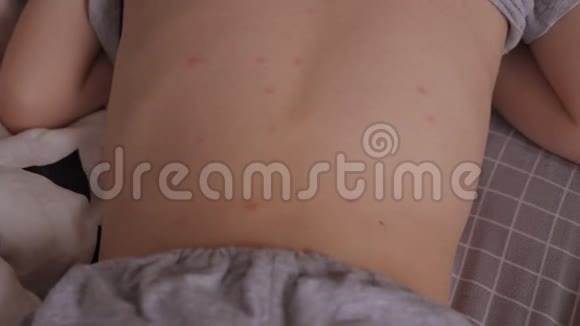 这个孩子皮肤上有很多水痘和天花视频的预览图
