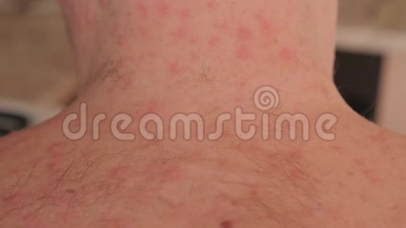一个患有水痘粉刺的成年男性的毛茸茸的背部和颈部视频的预览图