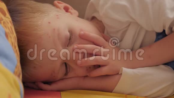 一个患有水痘的悲伤男孩躺在床上皮肤上有一个水泡视频的预览图