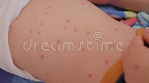一位母亲检查患有水痘的孩子发炎的皮肤视频的预览图