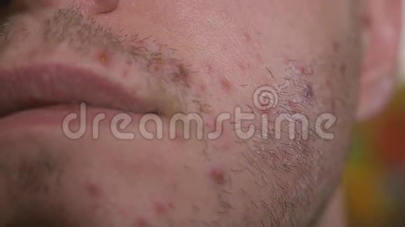 成年男性的脸和胡须上有许多红色的皮疹和麻点水痘视频的预览图