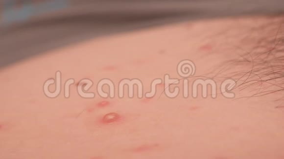 成年男性皮肤上的大皮疹或天花的特写视频的预览图
