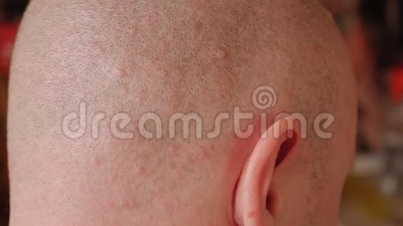 秃头男人的特写他的头上有水痘引起的皮疹视频的预览图
