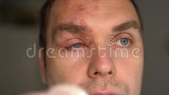 男子脸上有带状疱疹用棉垫处理脓疱视频的预览图