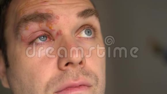 带着带状疱疹的男人脸上的特写的发炎的眼睑和红眼视频的预览图