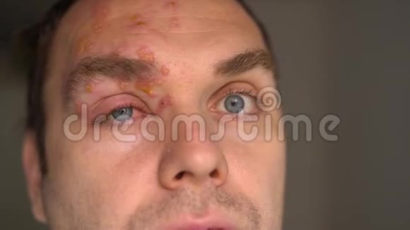 带状疱疹感染男性面部前额脓疱视频的预览图