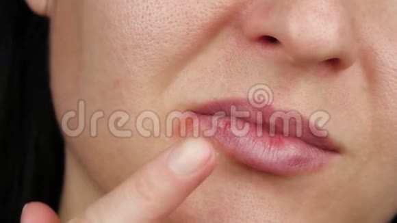 女性面部特写合并疱疹病毒病一个女人把药奶油放在疱疹发炎上医药视频的预览图