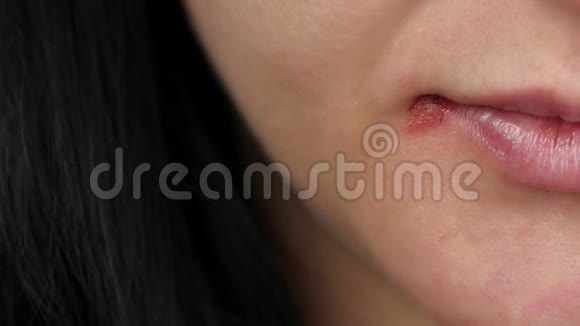 一部分女人的脸在特写一个女人嘴唇发炎疱疹视频的预览图