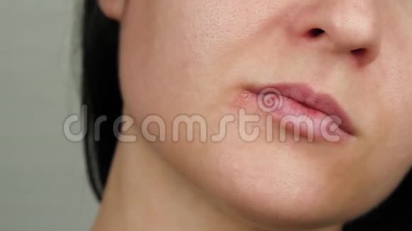一名唇部有疱疹病毒的妇女手里拿着一片覆盖着伤口医学和健康视频的预览图