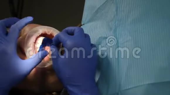 用特殊工具为陶瓷贴面准备病人牙齿暗影化妆品牙科视频的预览图