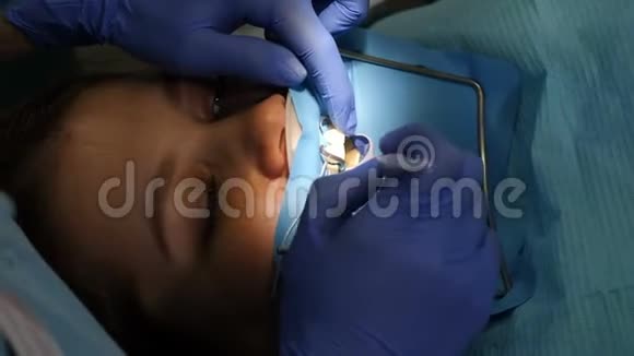 用特殊工具为陶瓷贴面准备病人牙齿暗影化妆品牙科视频的预览图