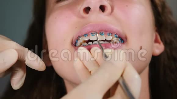 牙医在病人身上安装支架特写正畸治疗带牙牙套的牙齿重击视频的预览图