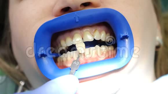 专业美容牙齿美白在现代牙科办公室在牙科诊所坐椅子的女病人医生视频的预览图