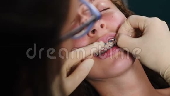 牙医在病人身上安装支架的过程特写正畸治疗带牙牙套的牙齿咬人视频的预览图