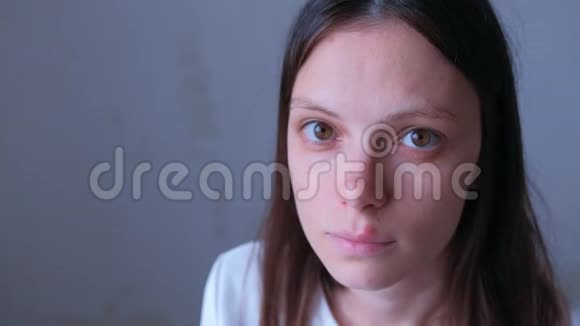 嘴唇上有疱疹病毒疮的女病人的照片视频的预览图